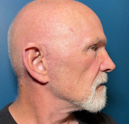 Facelift Before & After Patient #635