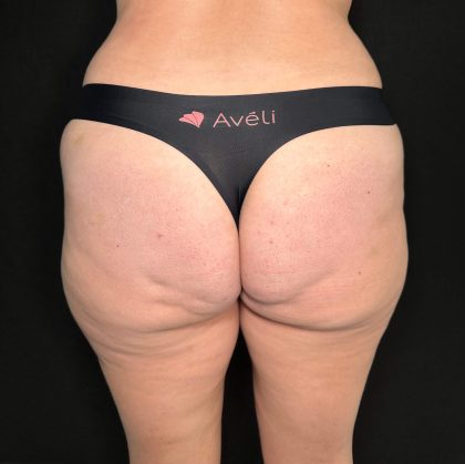Aveli Before & After Patient #501