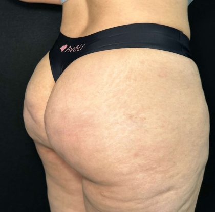 Aveli Before & After Patient #510