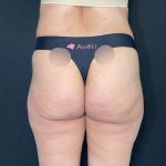Aveli Before & After Patient #531