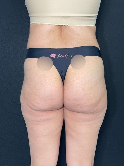Aveli Before & After Patient #531