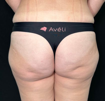 Aveli Before & After Patient #525