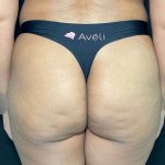 Aveli Before & After Patient #513