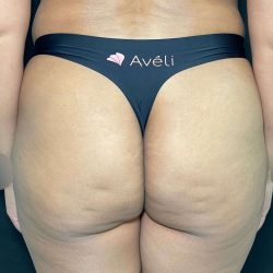 Aveli Before & After Patient #513