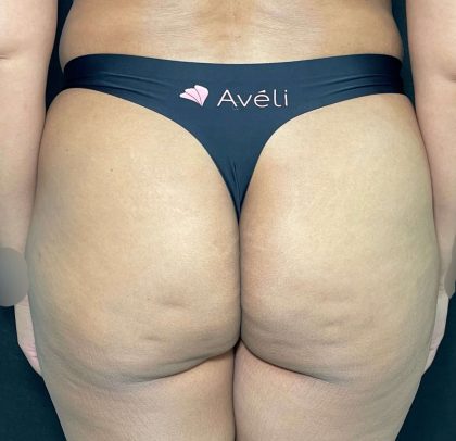 Aveli Before & After Patient #513