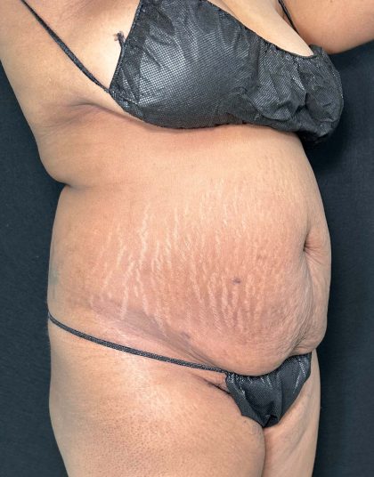 Tummy Tuck Before & After Patient #891