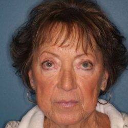 Facelift Before & After Patient #596