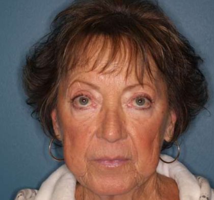 Facelift Before & After Patient #596