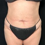 Tummy Tuck Before & After Patient #896