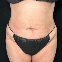 Tummy Tuck Before & After Patient #896