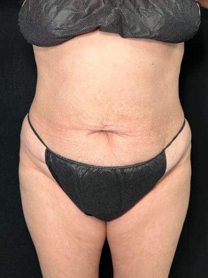 Tummy Tuck Before & After Patient #896