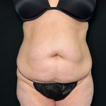 Tummy Tuck Before & After Patient #899