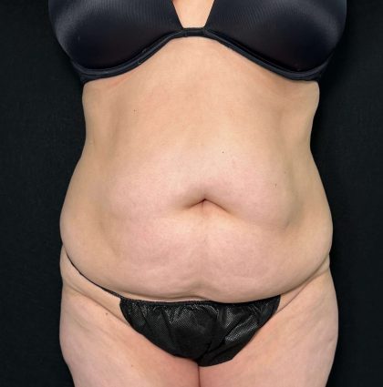 Tummy Tuck Before & After Patient #899
