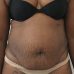 Tummy Tuck Before & After Patient #915