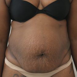Tummy Tuck Before & After Patient #915