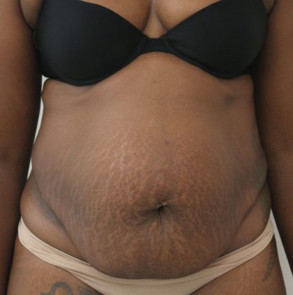 Tummy Tuck Before & After Patient #915