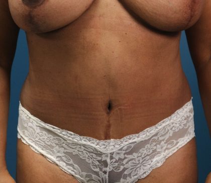 Tummy Tuck Before & After Patient #918