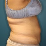 Tummy Tuck Before & After Patient #923