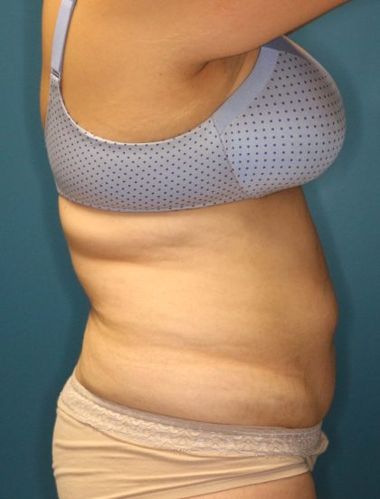 Tummy Tuck Before & After Patient #923