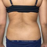 Liposuction Before & After Patient #858