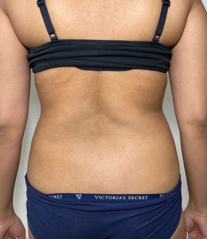 Liposuction Before & After Patient #858