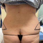 Tummy Tuck Before & After Patient #928