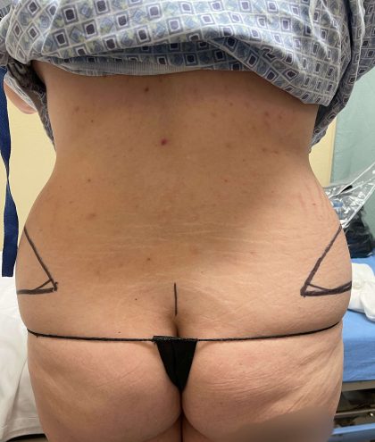 Tummy Tuck Before & After Patient #928
