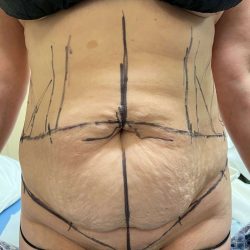 Tummy Tuck Before & After Patient #931