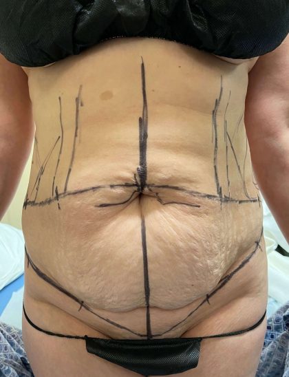 Tummy Tuck Before & After Patient #931