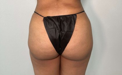 Brazilian Butt Lift Before & After Patient #563