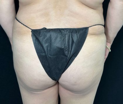 Brazilian Butt Lift Before & After Patient #560