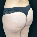Brazilian Butt Lift Before & After Patient #557