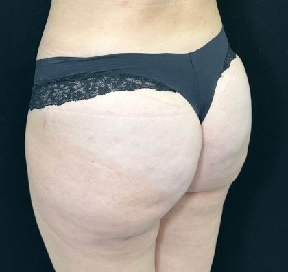Brazilian Butt Lift Before & After Patient #557