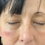 Eyelid Lift Before & After Patient #602