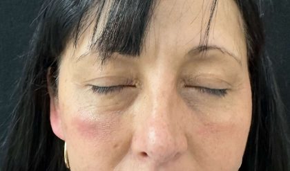 Eyelid Lift Before & After Patient #602