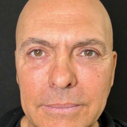 Eyelid Lift Before & After Patient #605