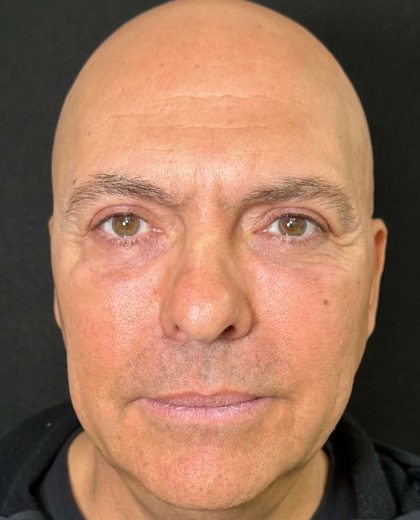 Eyelid Lift Before & After Patient #605