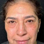 Eyelid Lift Before & After Patient #611