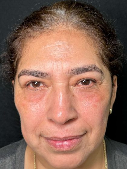 Eyelid Lift Before & After Patient #611