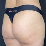 Aveli Before & After Patient #531