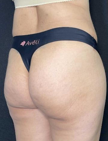 Aveli Before & After Patient #531