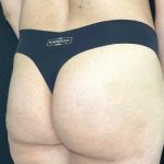 Aveli Before & After Patient #531
