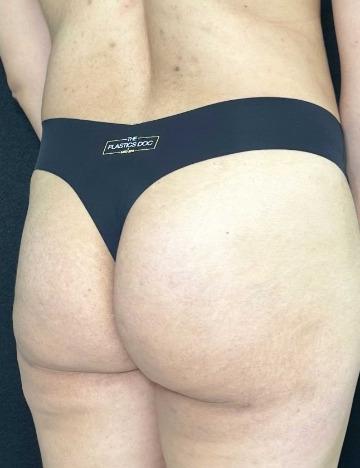 Aveli Before & After Patient #531