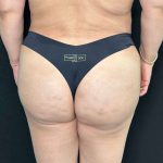 Brazilian Butt Lift Before & After Patient #560