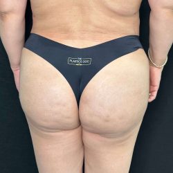 Brazilian Butt Lift Before & After Patient #560