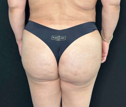 Brazilian Butt Lift Before & After Patient #560