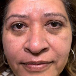 Eyelid Lift Before & After Patient #614