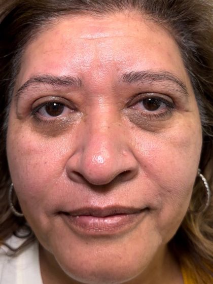 Eyelid Lift Before & After Patient #614