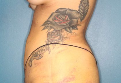 Liposuction Before & After Patient #792