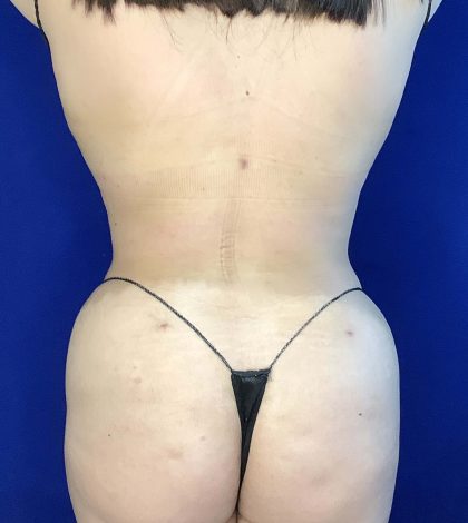 Liposuction Before & After Patient #809